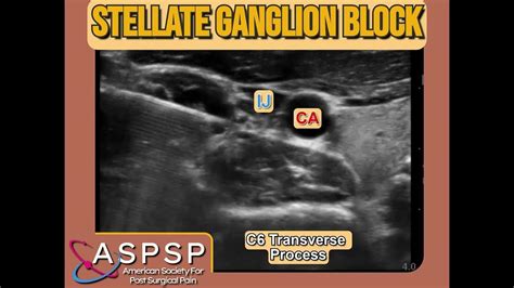 Ultrasound Guided Stellate Ganglion Block Youtube