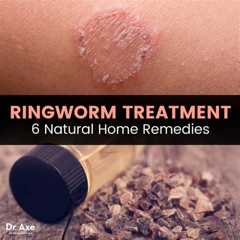 Ringworm is caused by a fungal infection that settles into the outer diagnosis of ringworm in cats. Ringworm Treatment: 6 Natural Remedies + How to Prevent It ...