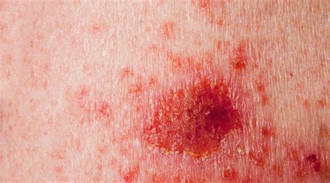There are several different types of skin cancer with basal cell carcinoma, squamous cell carcinoma, bowen's disease, keratoacanthoma, actinic keratosis and melanoma most commonly occurring. Signs of Late-Stage Skin Cancer