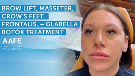 Brow Lift Masseter Frontalis And Glabella Botox Treatment Aafe