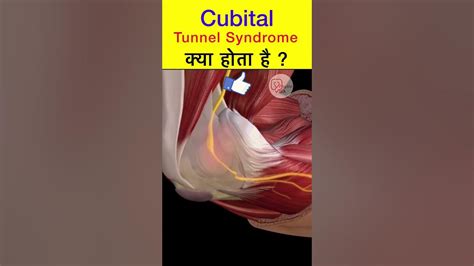 Cubital Tunnel Syndrome Cubital Tunnel Release Shorts