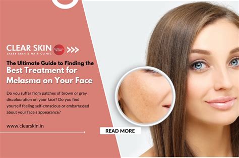 Guide To Finding The Best Treatment For Melasma On The Face