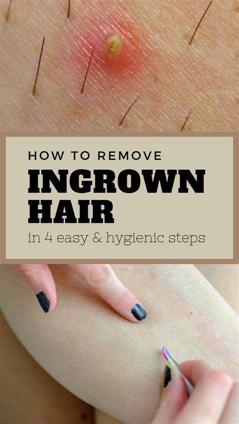 How To Remove Ingrown Hair In 4 Easy And Hygienic Steps Ingrown Hair