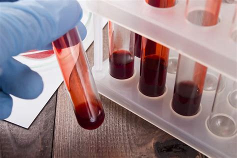تحليل cbc الدم الشامل مجلة البرونزية