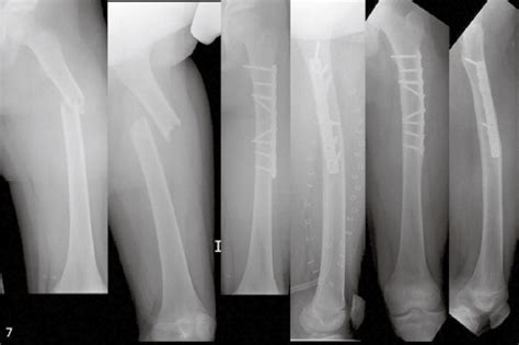 Iii° Closed Femoral Shaft Fracture With Manifest Compartment Syndrome