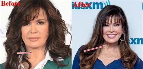 Marie Osmond Plastic Surgery Before And After Photos