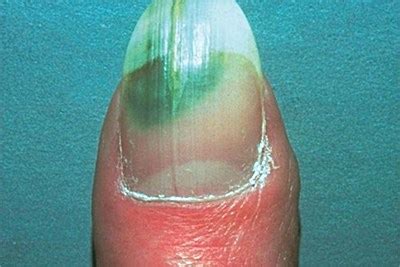 Water or moisture may get stuck under acrylic it could be water mold or green fungus, along with a general fungal attack. 10 Really Easy Ways to Make Dark Green Toenail Fungus Go ...