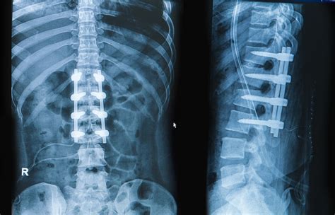 What Are The Permanent Restrictions After Spinal Fusion Surgery