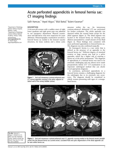 Pdf Acute Perforated Appendicitis In Femoral Hernia Sac Ct Imaging