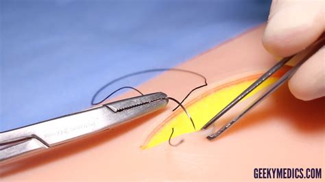 Deep Dermal Suture Osce Guide Surgical Skills Geeky Medics