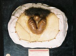 Pseudohermaphroditismus, scheinzwittertum, organisch bedingte sexuelle störung, bei der im gegensatz zum echten zwittertum das chromosomale geschlecht… Moulage, Pseudohermaphroditismus externa / Zwitterbildung ...