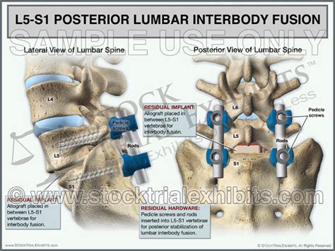 L5 S1 Posterior Lumbar Interbody Fusion Plif Stock Trial Exhibits