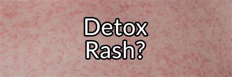 Detox Rash Myth Or Fact