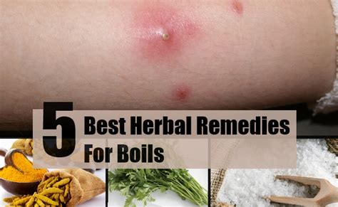 5 Best Herbal Remedies For Boils Treatments And Cure For Boils Find