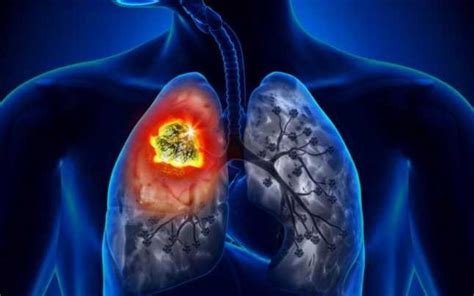 Cancerul Pulmonar Tipuri Simptome Diagnosticare Etape Tratament
