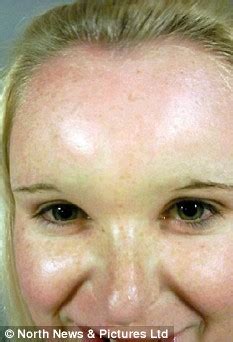 You don't always need fillers or botox to get rid of forehead wrinkles and frown lines! Teenage girl's head 'doubles in size' after drinking an ...