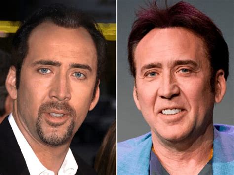 14 Celebrity Hair Transplants You Must See Bald And Beards