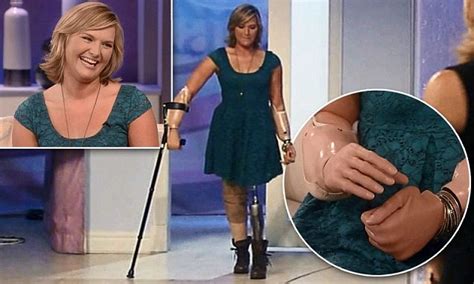 Flesh Eating Bacteria Survivor Aimee Copeland Shows Off Her Bionic Hands As She Appears On Katie