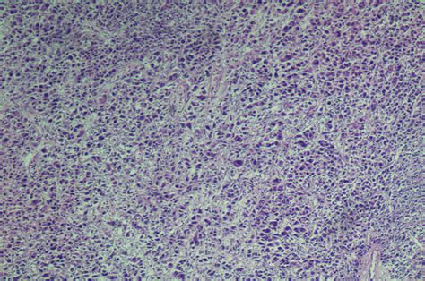 Cureus Malignant Perivascular Epithelioid Cell Tumor Of The Uterus