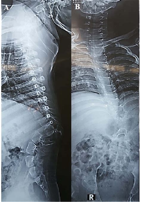 Preoperative A Lateral Plain X Ray Showing Acute Kyphosis B