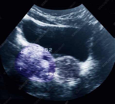 Dermoid Ovarian Cyst Ultrasound Scan Stock Image C0337377