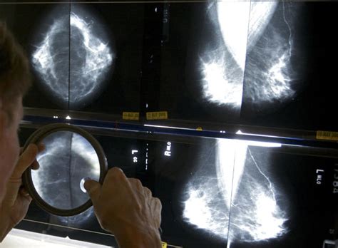 us to require breast density information after mammograms