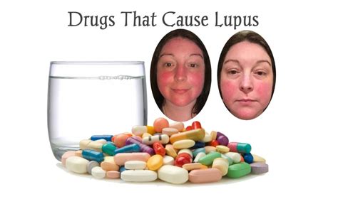 What Are The 38 Drugs That Cause Drug Induced Lupus Meds Safety