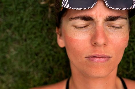 Sunburn Causes Risks Symptoms And Prevention Strategies Index Of