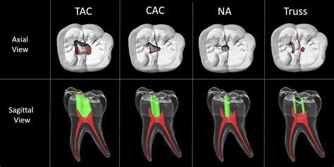 Access Cavity Preparations Classification And Literature Review Of Traditional And Minimally
