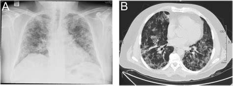 Lung Imaging Showing Diffuse Interstitial Lung Disease A Chest Free