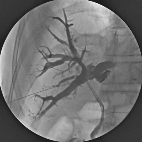 We did not find results for: Percutaneous transhepatic biliary drainage (PTBD ...
