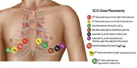 Image Result For 12 Lead Ecg Placement Ekg Placement