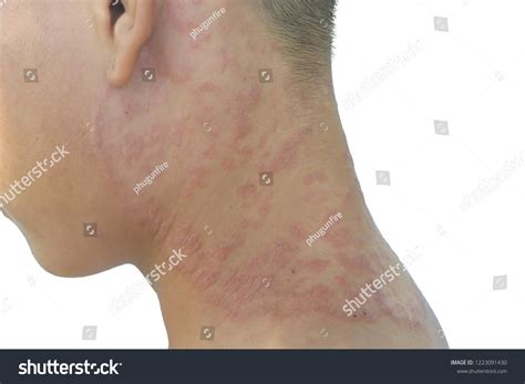 Fungal Skin Disease Neck On White Stock Photo 1223091430 Shutterstock