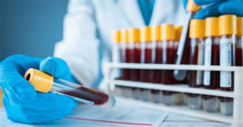 How Accurate Are Routine Laboratory Tests For Diagnosis Of Covid 19