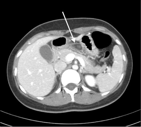 Contrast Enhanced Abdominal Ct Scan Shows A Fat Attenuated Lesion With