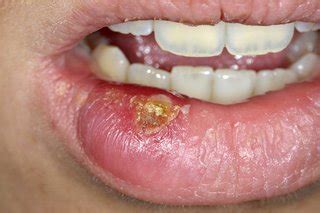 Lip and oral cavity cancer may not have any symptoms and is if cancer is in the upper gingiva (gums) or the hard palate (the roof of the mouth), treatment is usually surgery (wide local. Cold sores - NHS