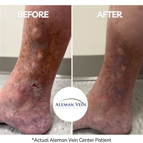 Aleman Vein Center Is An Atlanta Vein Clinic That Offers The Best