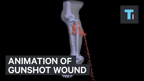 Animation Of Gunshot Wound Youtube
