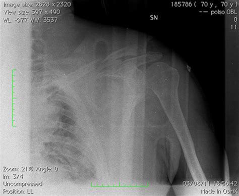 Plain Radiography Showing Left Midshaft Clavicular Fracture Download