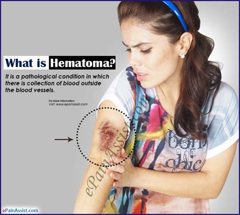 What Is Hematomatypescausessymptomstreatmentprognosis