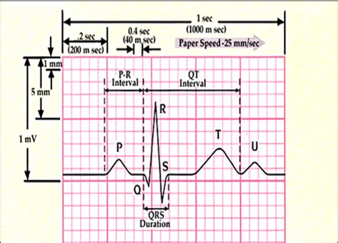 How To Read An Ecg Physical Therapy Reviewer