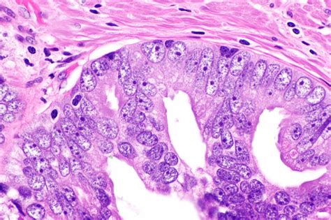 While they are a form of neoplasm , there is disagreement over whether cis should be classified as cancer. Malignant Prostate Tumor Is A Silent Killer | IFHNOS ...