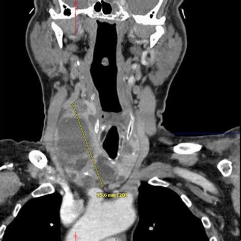 Cervical Computed Tomography Enlarged Right Thyroid Lobe Ap W Cc