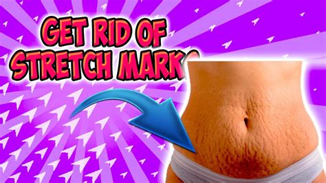 How To Get Rid Of Stretch Marks Naturally Fast Get Rid Of Stretch Marks Youtube