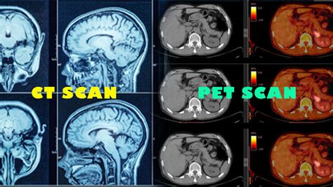 Pet Scan Vs Ct Scan Similarities And Differences Hot Sex Picture
