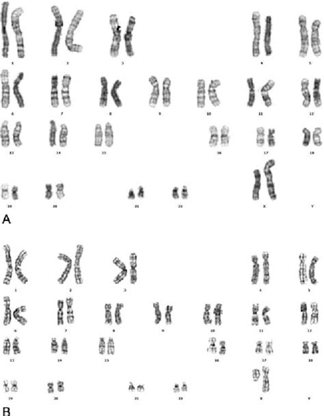 Figure 1 From Inconsistency Of Karyotyping And Array Comparative