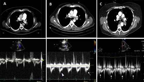 A Doppler Echocardiographic Pulmonary Flow Marker Of Massive Or