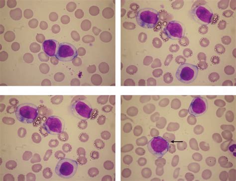 Increased Numbers Of Lymphoma Cells In The Peripheral Blood The Cell