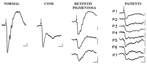 Full Field Electroretinograms In A Normal Subject A Congenital