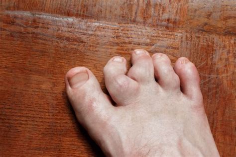 Learn About Toe Deformities Instride Crystal Coast Podiatry